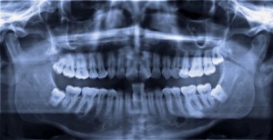 Sind Zahnimplantate wirklich ungefährlich?